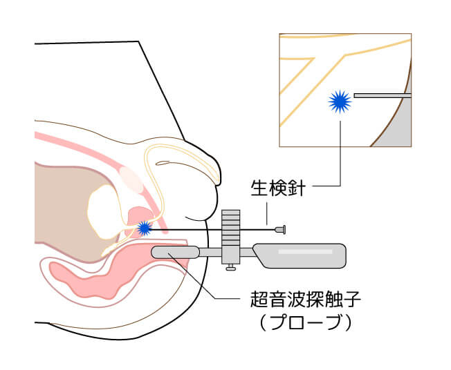 経会陰式針生検の様子